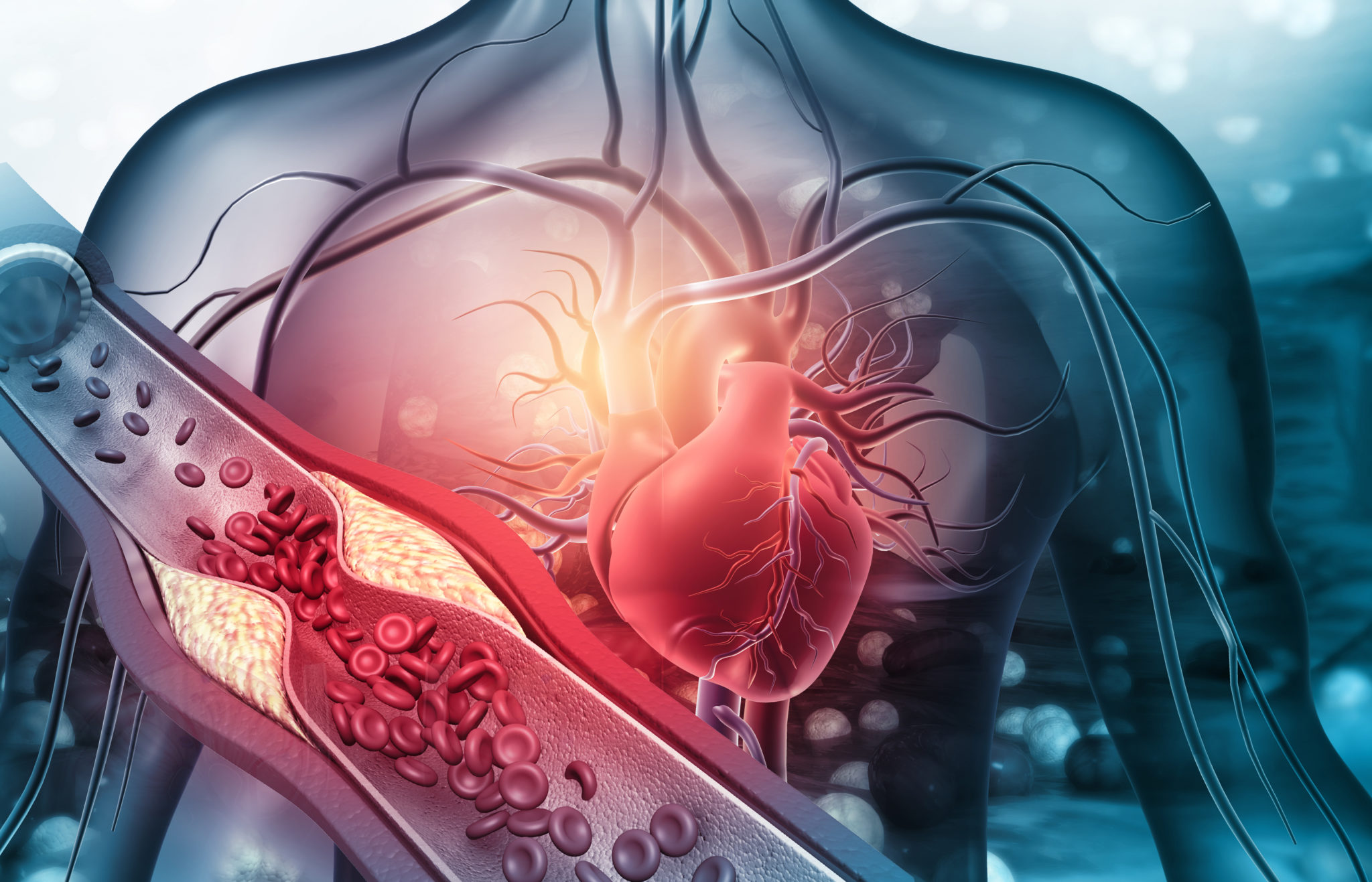 What A High LDL Particle Number Means For Developing Atherosclerosis