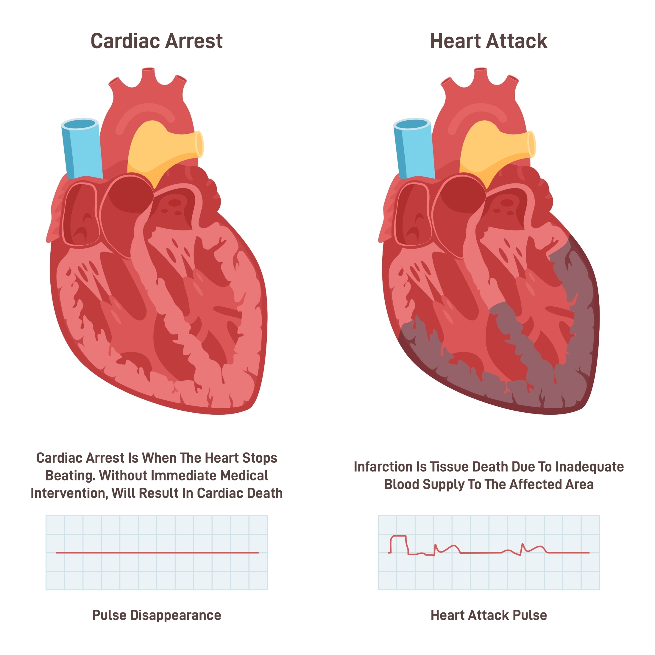 Heart Attack Diagram Heart Attack Diagram