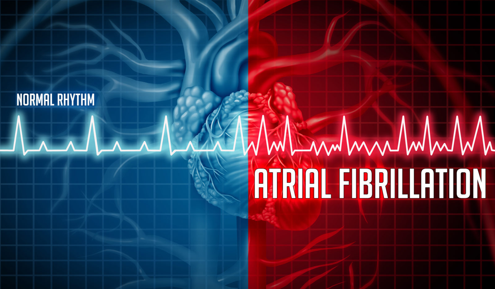 The Afib Diet How To Prevent Afib Attacks Naturally Showit Blog