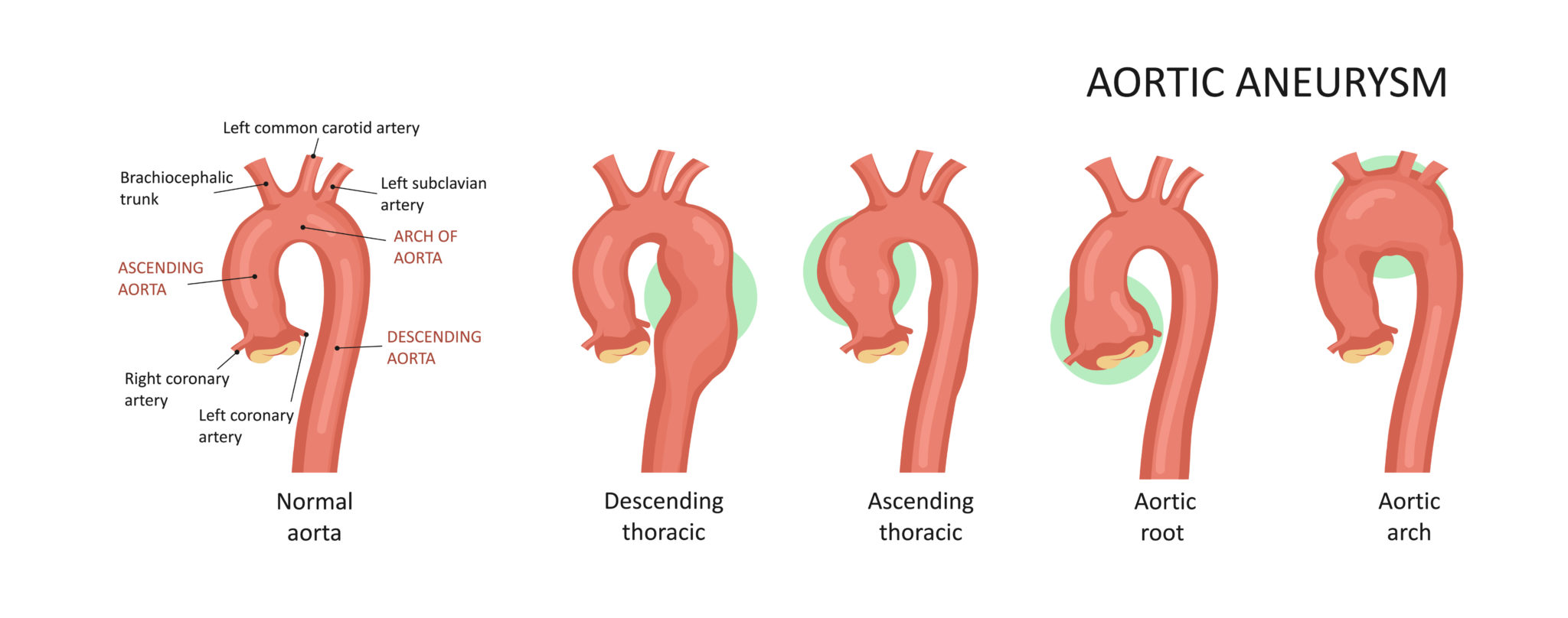 What Is Aortic Root Dilatation Showit Blog