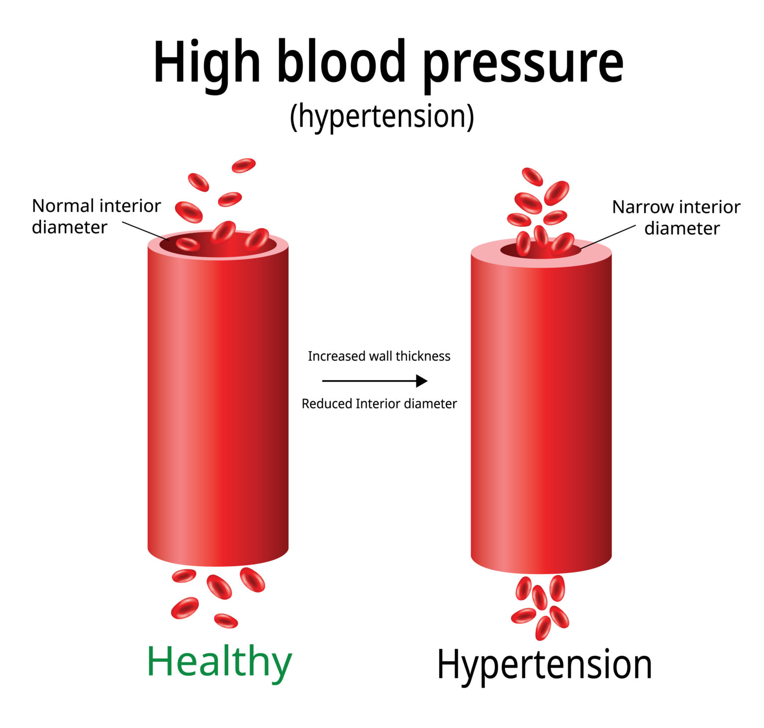 mounjaro-zepbound-weight-loss-drugs-may-help-lower-blood-pressure