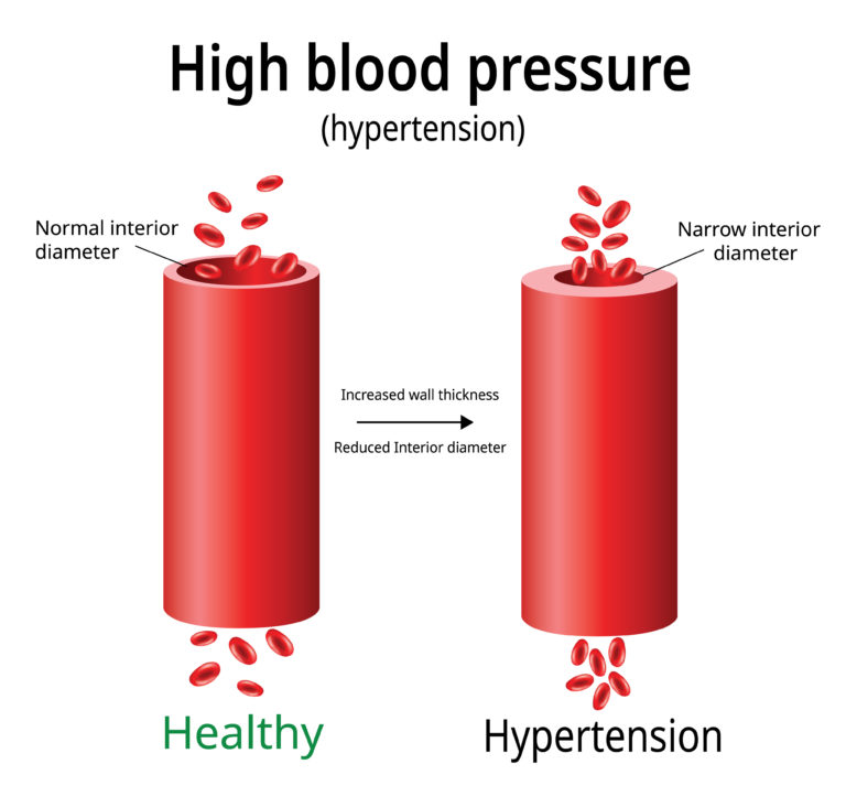 how-to-lower-blood-pressure-naturally-showit-blog