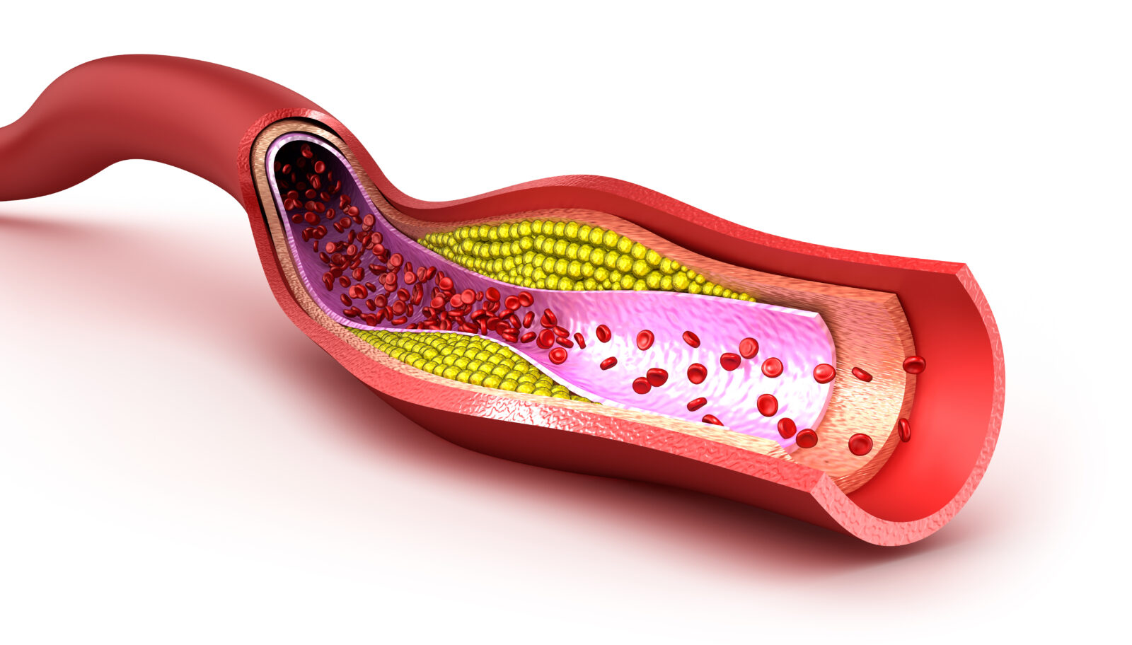 does-high-cholesterol-cause-heart-attacks-showit-blog