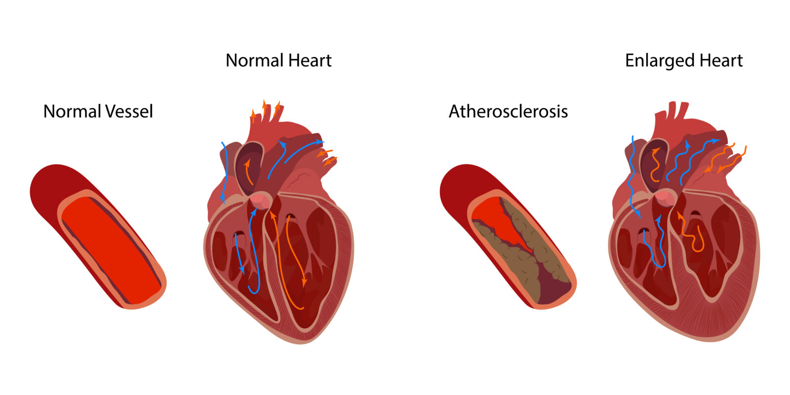 What is an Enlarged Heart? - Showit Blog