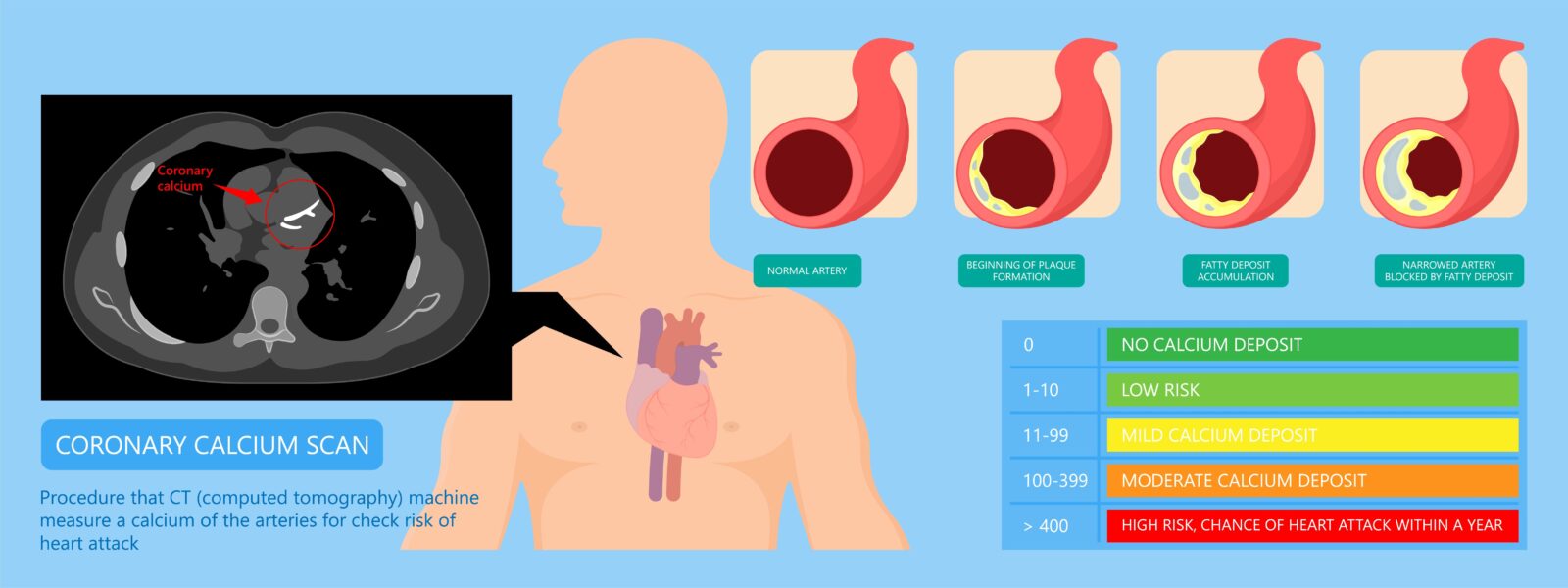 What is Your Calcium Heart Score? Plus What to Do if You Have a High ...