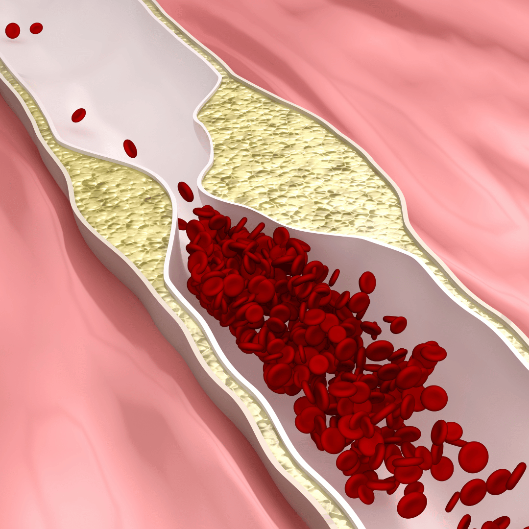 artery with plaque to discuss what causes plaque buildup in arteries