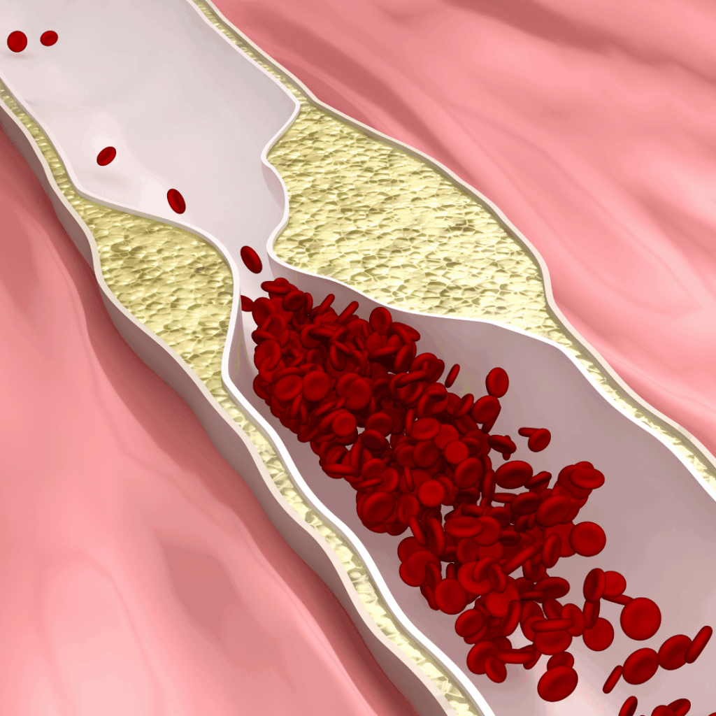 Image of plaque build up in the arteries to show what causes plaque in the arteries