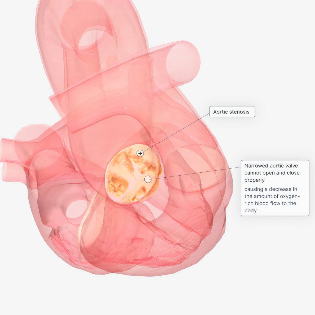 aortic stenosis treatment and anatomy