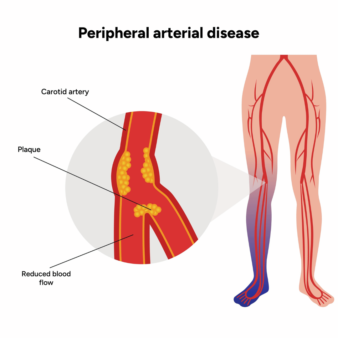 peripheral artery disease diet